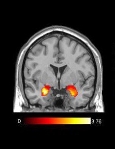 Amygdala activation