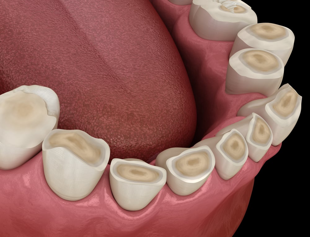 Dental,Attrition,(bruxism),Resulting,In,Loss,Of,Tooth,Tissue.,Medically