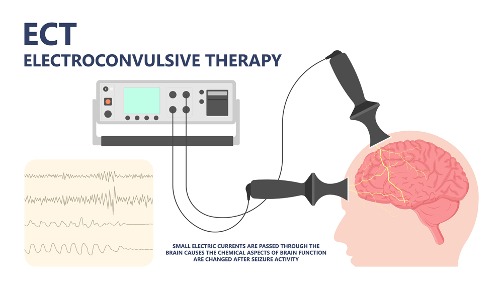 ECT treat MDD Major TMS electric current brain mental health mania bipolar loss Physical head EEG activity signal severe OCD therapist shock deep anxiety Post disease emotional Stigma