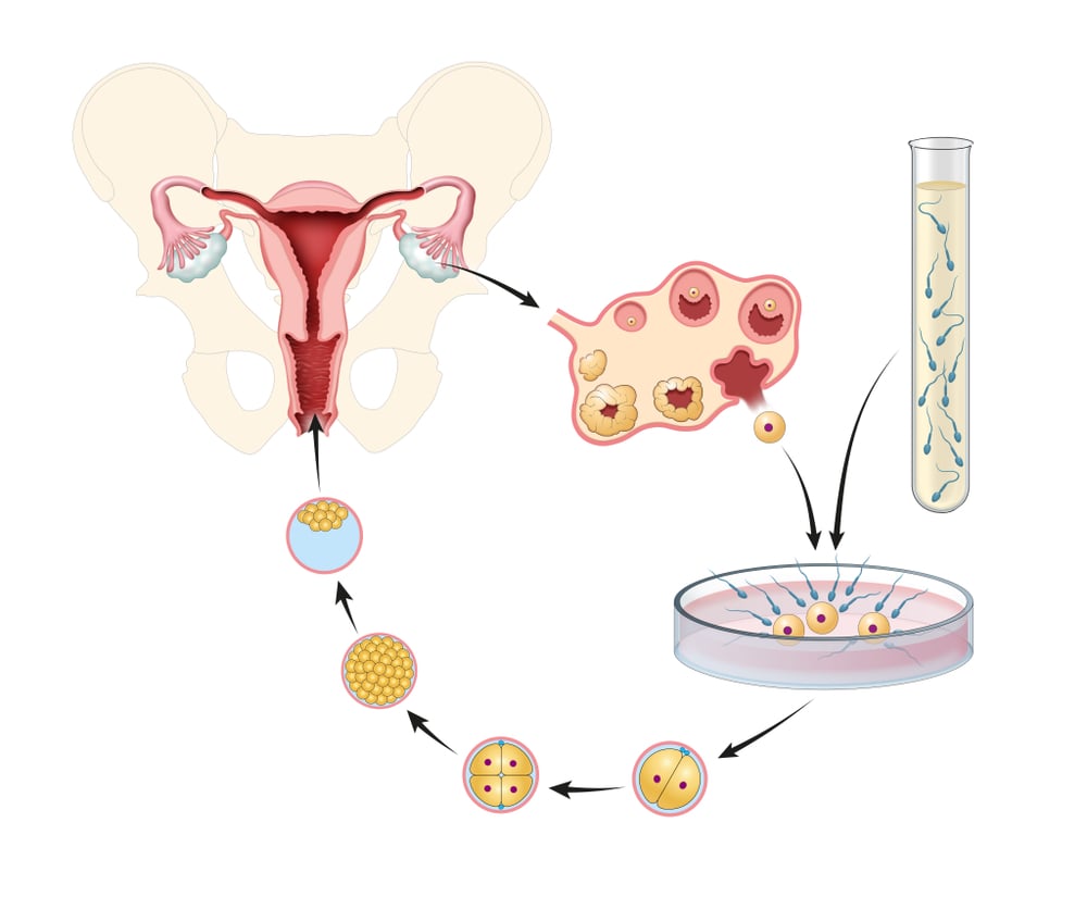 Artificial,Insemination.,In,Vitro,Fertilization.,Illustration