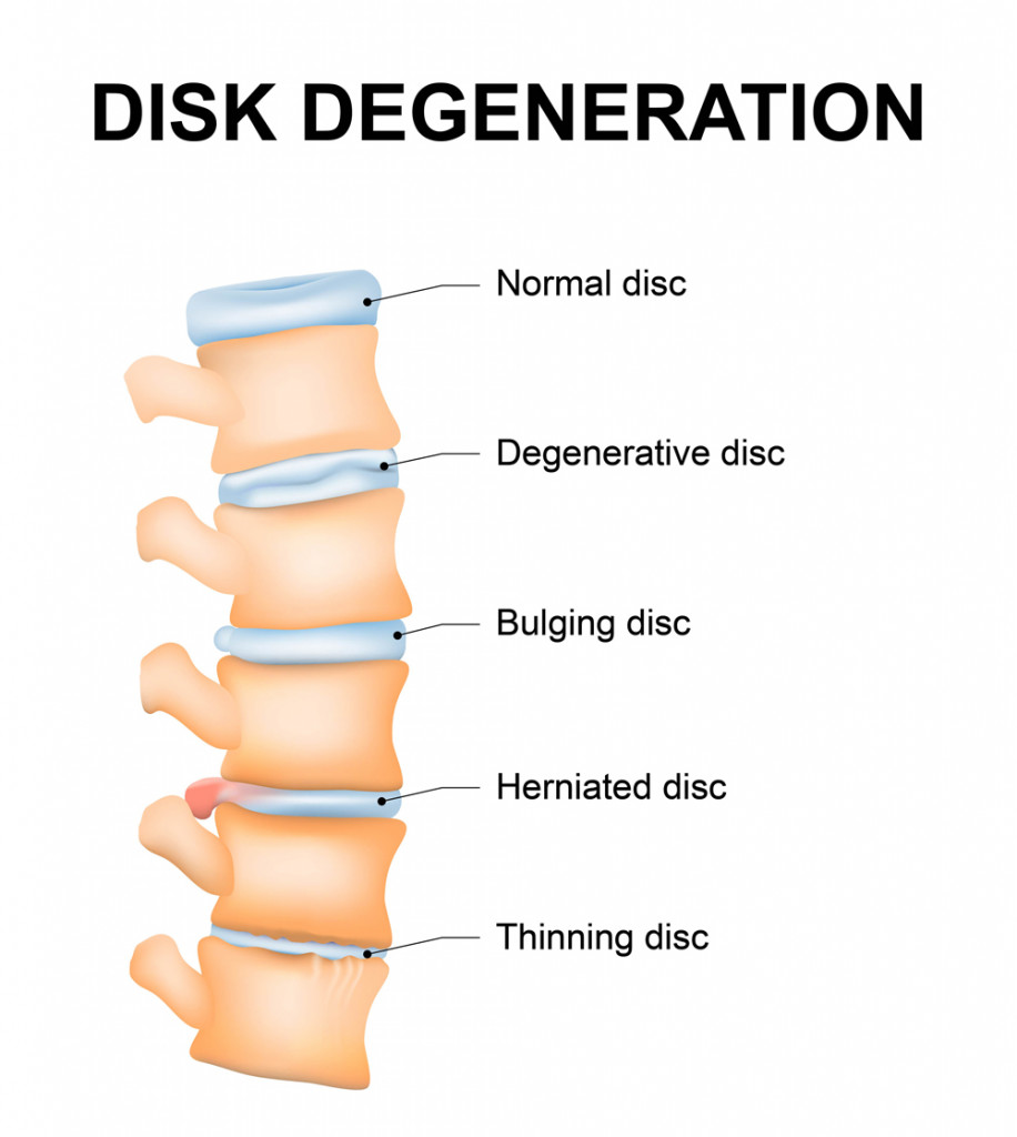 Degeneração do disco é o processo normal de desgaste do envelhecimento da coluna