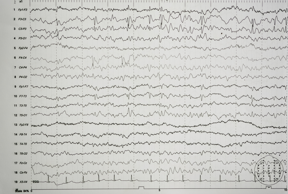 Eeg,Wave,In,Human,Brain,abnormal,Eeg,brain,Wave,On,Electroencephalogram,,eeg