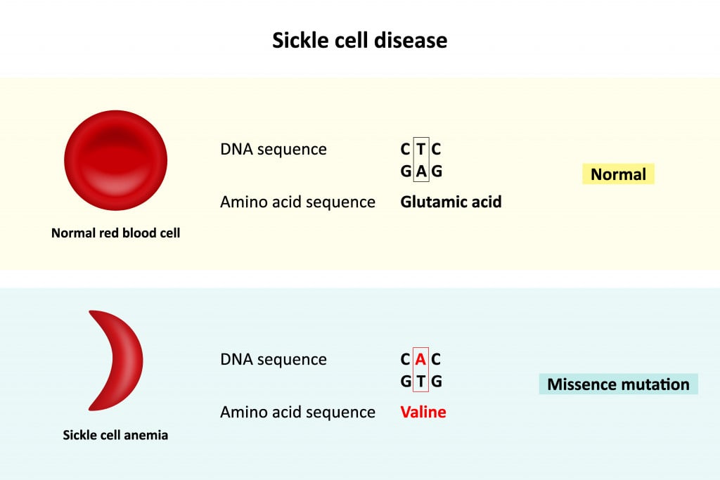 Sickle cell disease, Comparison of DNA sequence between Normal red blood cell and Sickle cell anemia, Scientific study