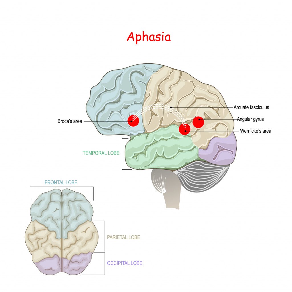 Aphasia