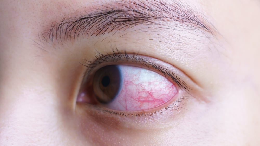 Red,Bloodshot,Eye,Of,Woman,,Irritated,Or,Infected,,Conjunctivitis,Eye