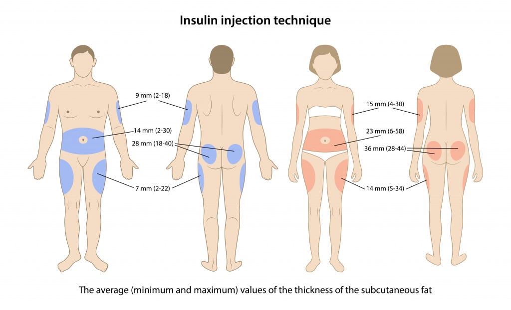 minimum and maximum values of the thickness of the subcutaneous fat on the insulin injection sites are shown on male and female bodies
