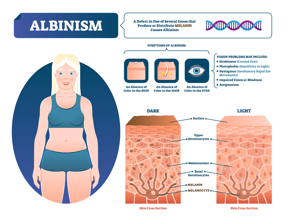 Albinism vector illustration. Labeled medical melanin pigment loss scheme. Genetic problem with skin, eyes, eyebrows and hair color symptoms. Compared normal skin cross section with lack of melanocyte