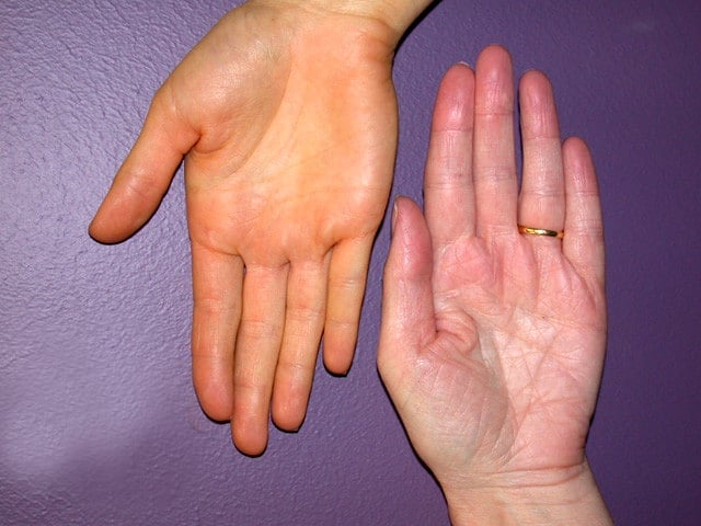 Image showing normal palm colour on the right and the yellowish discolouration seen in carotenemia on the left