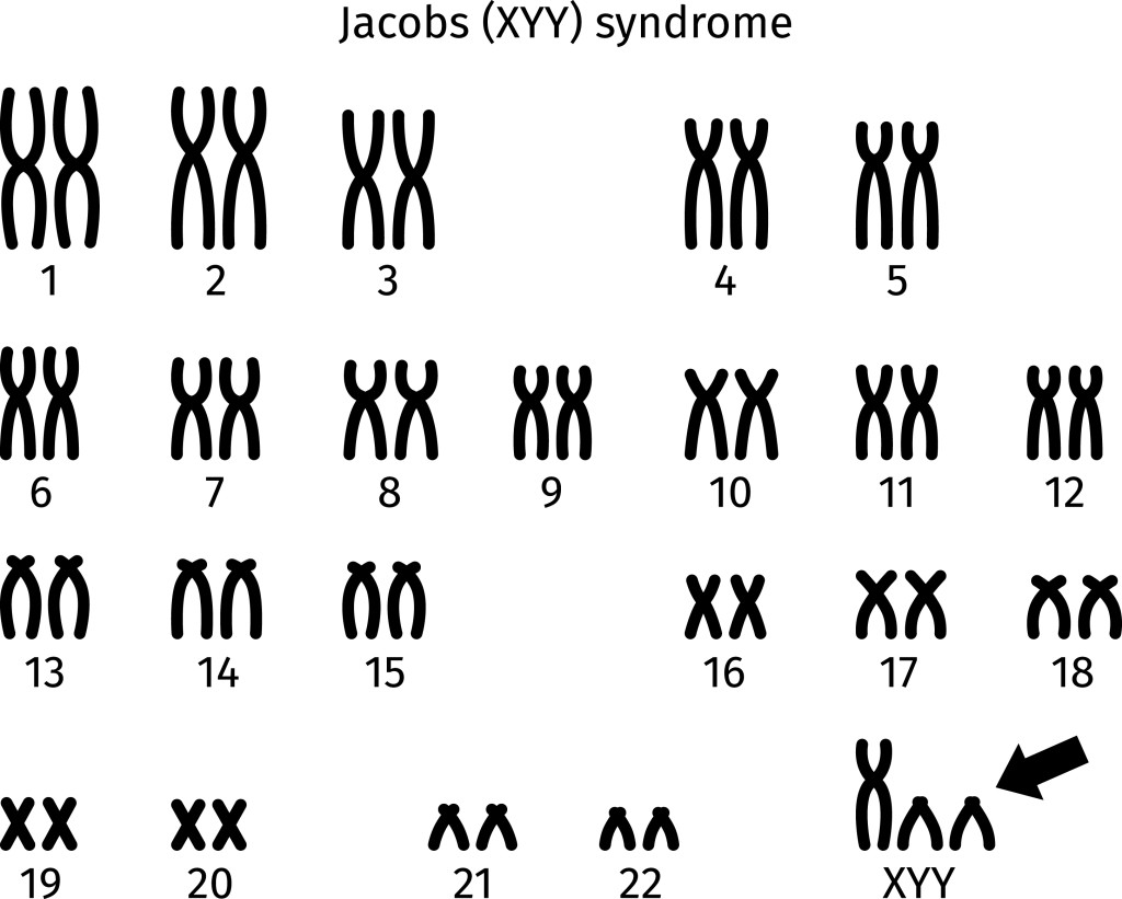 Esquema do cariótipo da síndrome de Jacobs (XYY) da célula somática humana